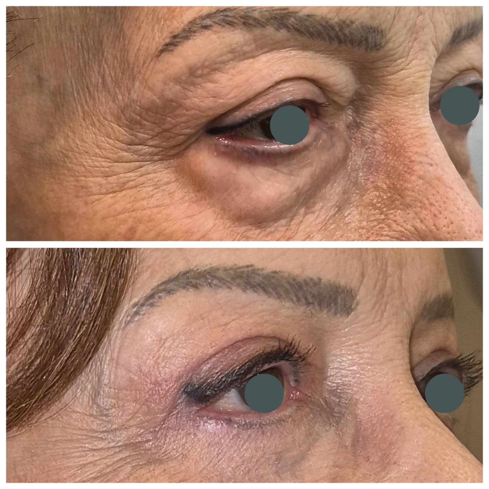 Antes e depois de blefaroplastia 4